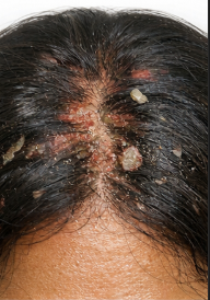 Diagnosed scalp issue