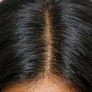 Clean scalp