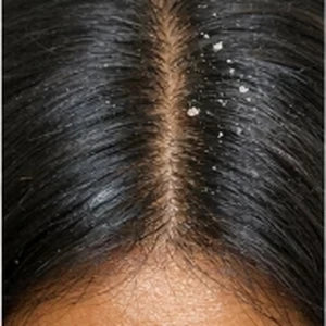 Mild flaking